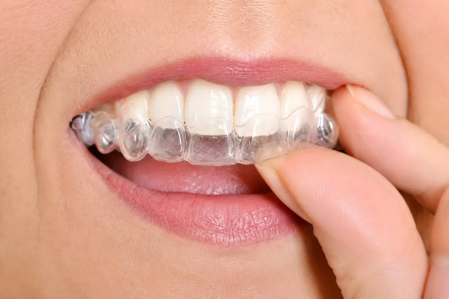 Person fitting clear dental aligner on teeth.